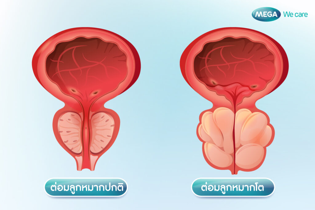 วิธีสังเกตอาการ ต่อมลูกหมากโต 
