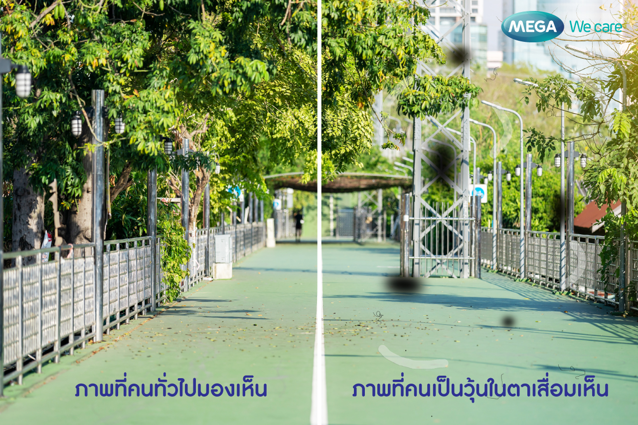 อาการของคนเป็น วุ้นในตาเสื่อม