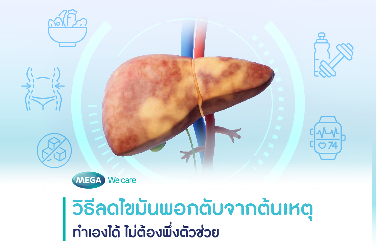 วิธีลดไขมันพอกตับ ด้วยตนเอง