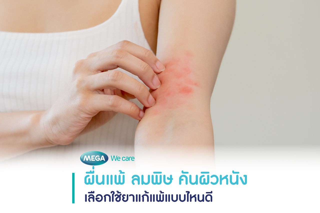 ยาแก้แพ้ ผื่นแพ้ ลมพิษ คัน