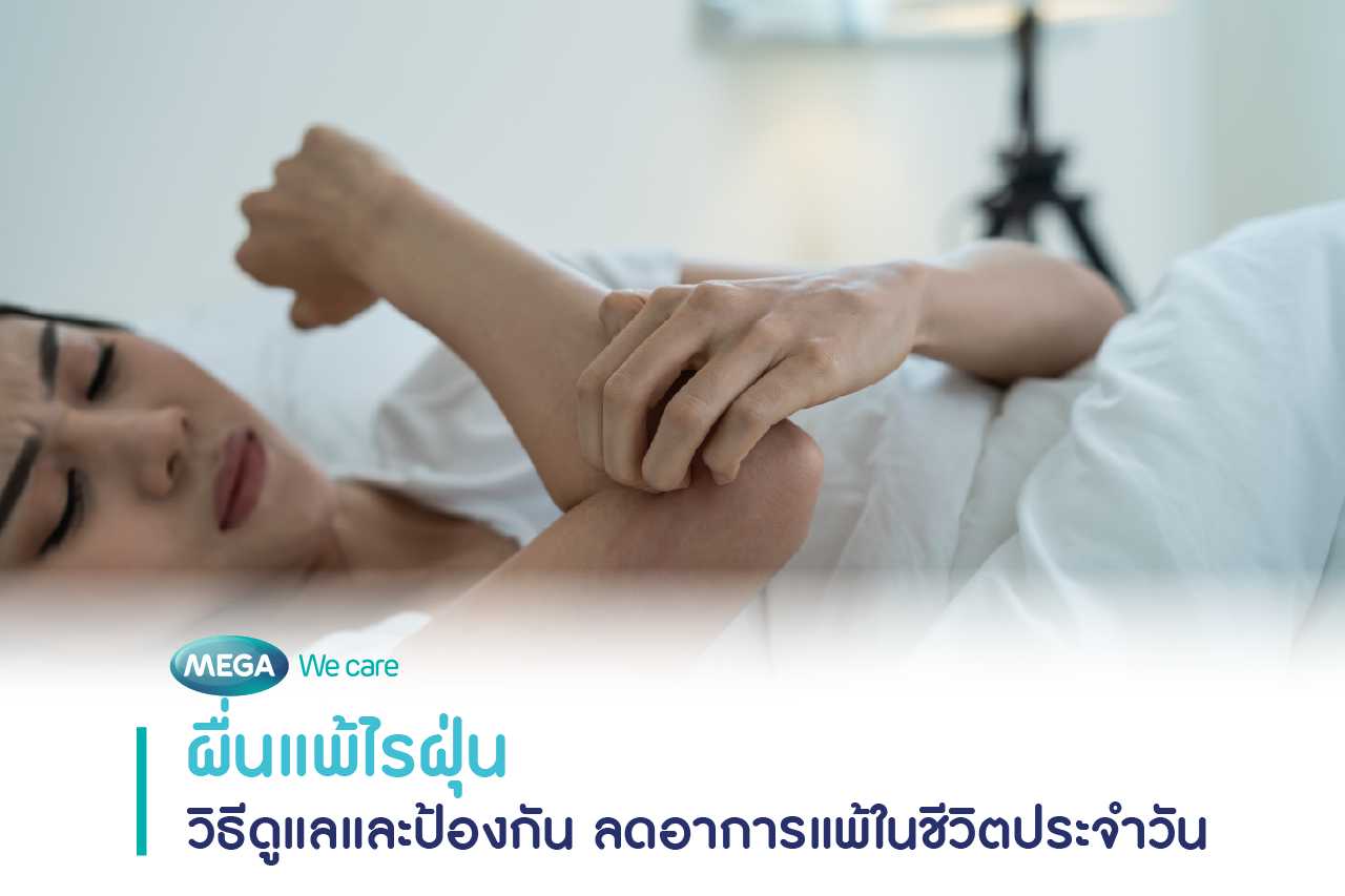 ผื่นแพ้ไรฝุ่น ลักษณะเป็นผื่นแดงเล็ก ๆ เป็นหย่อม ๆ หรือเป็นบริเวณกว้าง มักมีอาการคันร่วมด้วย