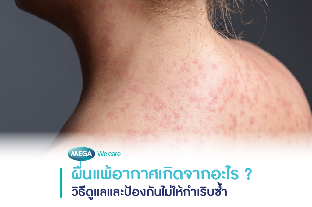ผู้หญิงประสบปัญหาผื่นแพ้อากาศขึ้นตามร่างกาย