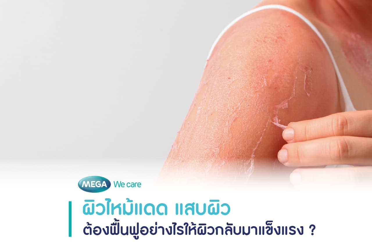 ผิวหนังลอกหลังตากแดดเป็นอาการของผิวไหม้แดด