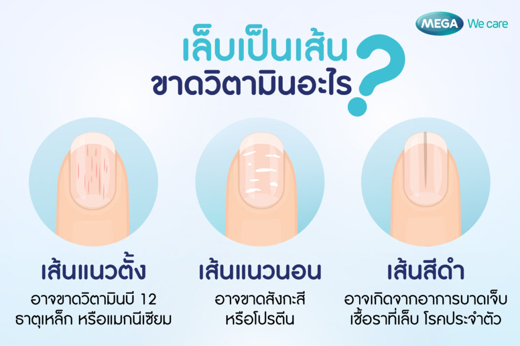 เล็บเป็นเส้น เกิดจากอะไร ขาดวิตามินอะไร