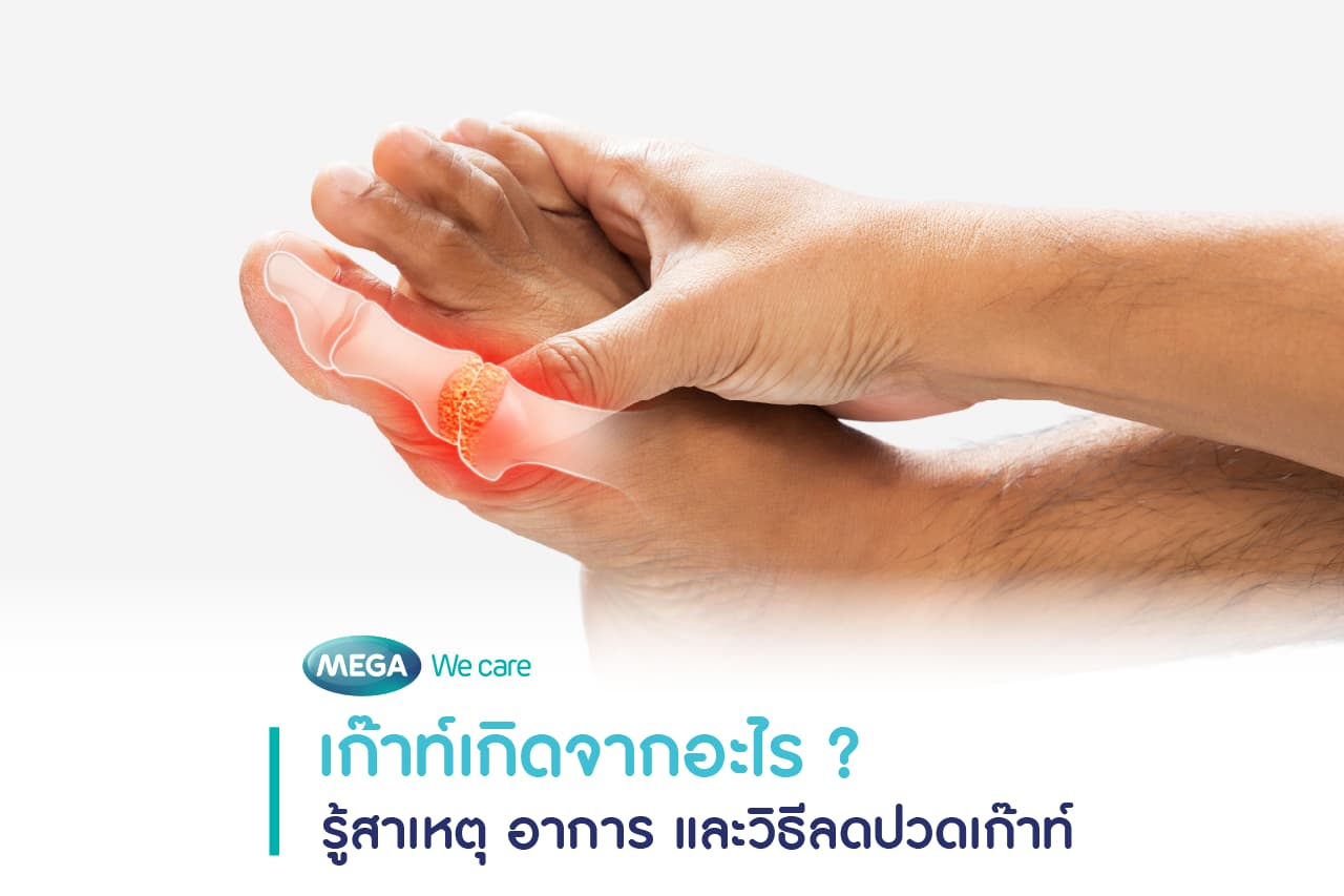 เก๊าท์ เป็นโรคข้ออักเสบชนิดหนึ่งที่เกิดขึ้นเมื่อร่างกายมีกรดยูริกในเลือดสูงต่อเนื่อง